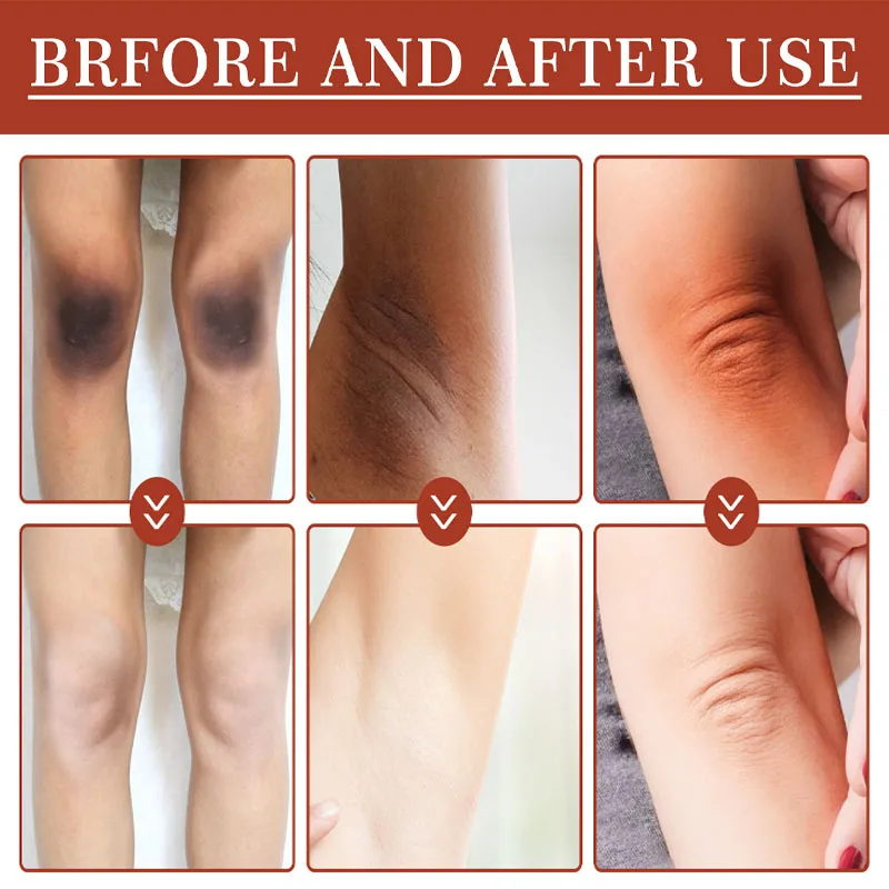 Dark Knuckles Fast Brighten Serum Elbows Hand Knuckle Brightening Serum Knee Black Skin Quickly Lighten Stains Remover Essence
Dark Knuckles Fast Brighten Serum Elbows Hand Knuckle Brightening Serum Knee Black Skin Quickly Lighten Stains Remover Essence