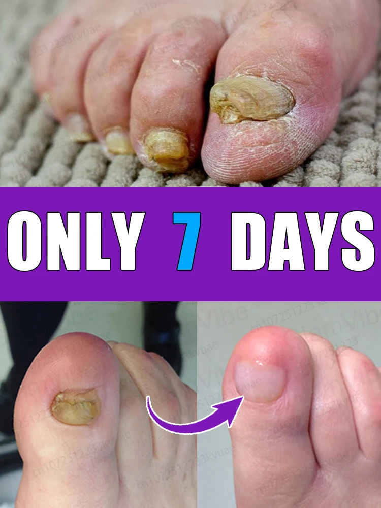 Rapid penetrate, nails glassy-transparent, fungus eliminated in 7 days
Rapid penetrate, nails glassy-transparent, fungus eliminated in 7 days