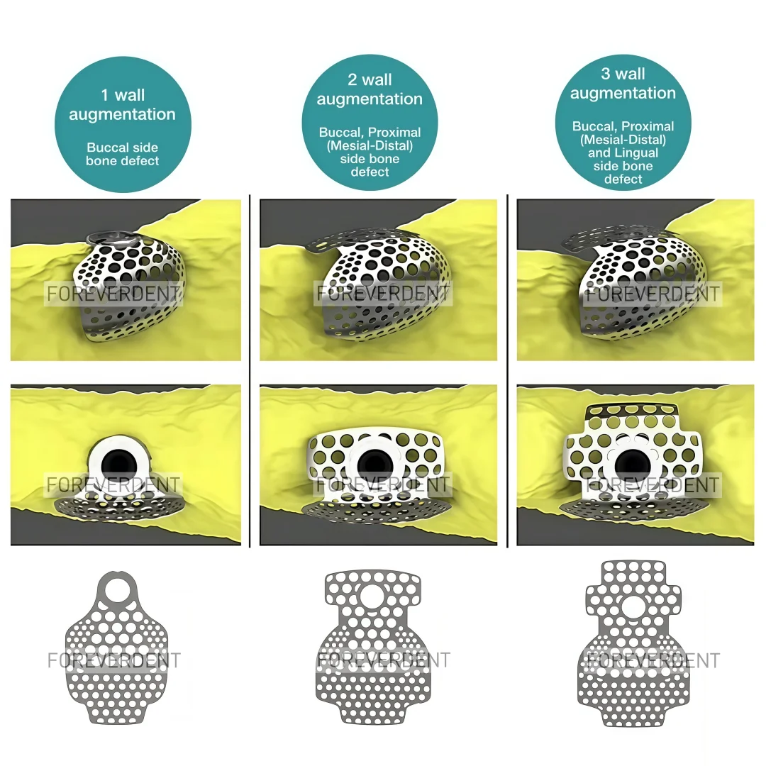 10pcs Dental Titanium Mesh GBR Bone Incremental Membrane Implant Sidewall Bone Regeneration Titinium Safe Flexible Mesh
10pcs Dental Titanium Mesh GBR Bone Incremental Membrane Implant Sidewall Bone Regeneration Titinium Safe Flexible Mesh