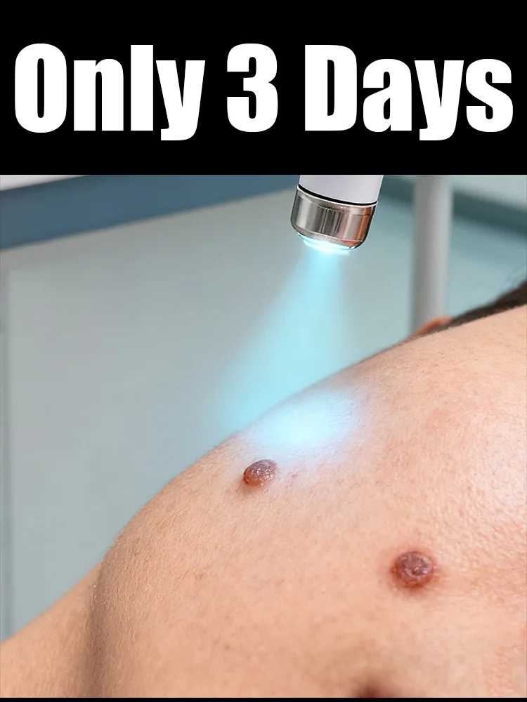 The first generation of improved wart repair agent wart root fast
The first generation of improved wart repair agent wart root fast