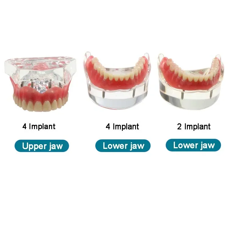 Dentist Teaching Teeth Model Dental Teeth Model with Implant Removeble Bridge Denture Demo Model
Dentist Teaching Teeth Model Dental Teeth Model with Implant Removeble Bridge Denture Demo Model