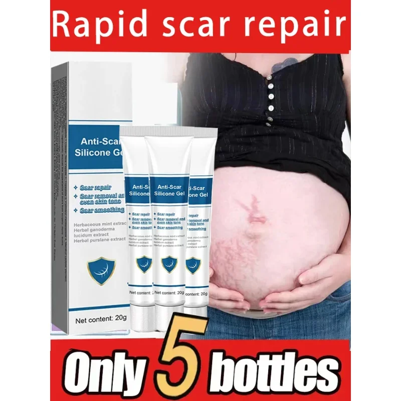 Cream For Pregnancy Stretch Marks Removal Eliminate Red White Old Stretch Marks Oil
Cream For Pregnancy Stretch Marks Removal Eliminate Red White Old Stretch Marks Oil