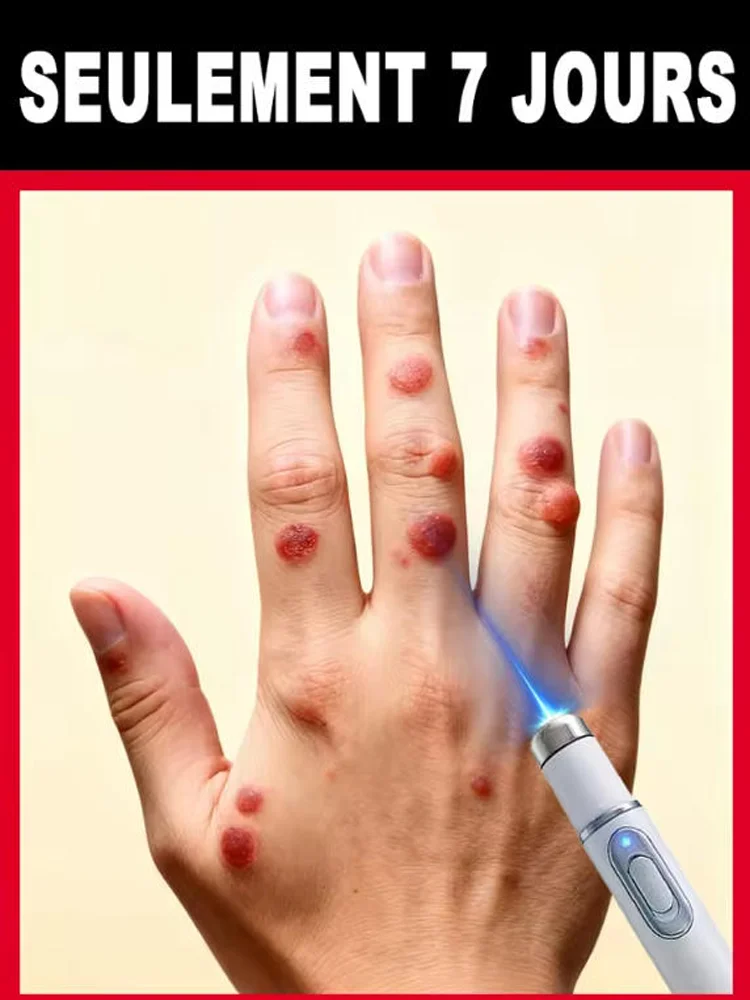 Laser pen point application wart removal, ᵖᵃⁱⁿˡᵉˢˢ ʷᵃʳᵗ ʳᵉᵐᵒᵛᵃˡ ᵃⁿᵈ ᵖʳᵉᵛᵉⁿᵗ ᵈᵃᵐᵃᵍᵉ
Laser pen point application wart removal, ᵖᵃⁱⁿˡᵉˢˢ ʷᵃʳᵗ ʳᵉᵐᵒᵛᵃˡ ᵃⁿᵈ ᵖʳᵉᵛᵉⁿᵗ ᵈᵃᵐᵃᵍᵉ