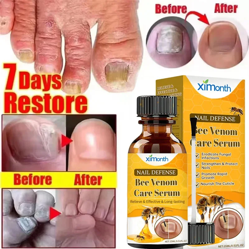 Nail Fungal Treatment Serum Foot Toe Nail Fungus Removal Essential Oil Anti Infection Onychomycosis Paronychia Repairing Care
Nail Fungal Treatment Serum Foot Toe Nail Fungus Removal Essential Oil Anti Infection Onychomycosis Paronychia Repairing Care