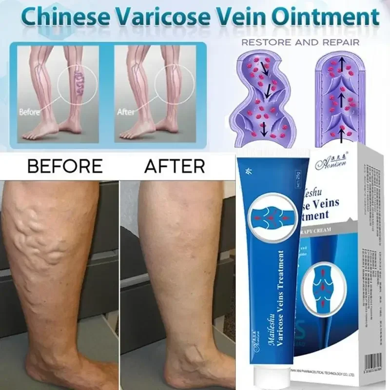 Varicose Veins Cream Spider Ointment Natural Treatment Relief Phlebitis Angiitis Leg Smearing Cream Remedies
Varicose Veins Cream Spider Ointment Natural Treatment Relief Phlebitis Angiitis Leg Smearing Cream Remedies