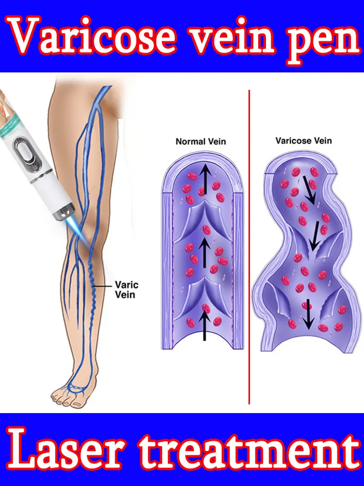 Using nanotechnology to deeply remove varicose veins, phlebitis and spider legs
Using nanotechnology to deeply remove varicose veins, phlebitis and spider legs