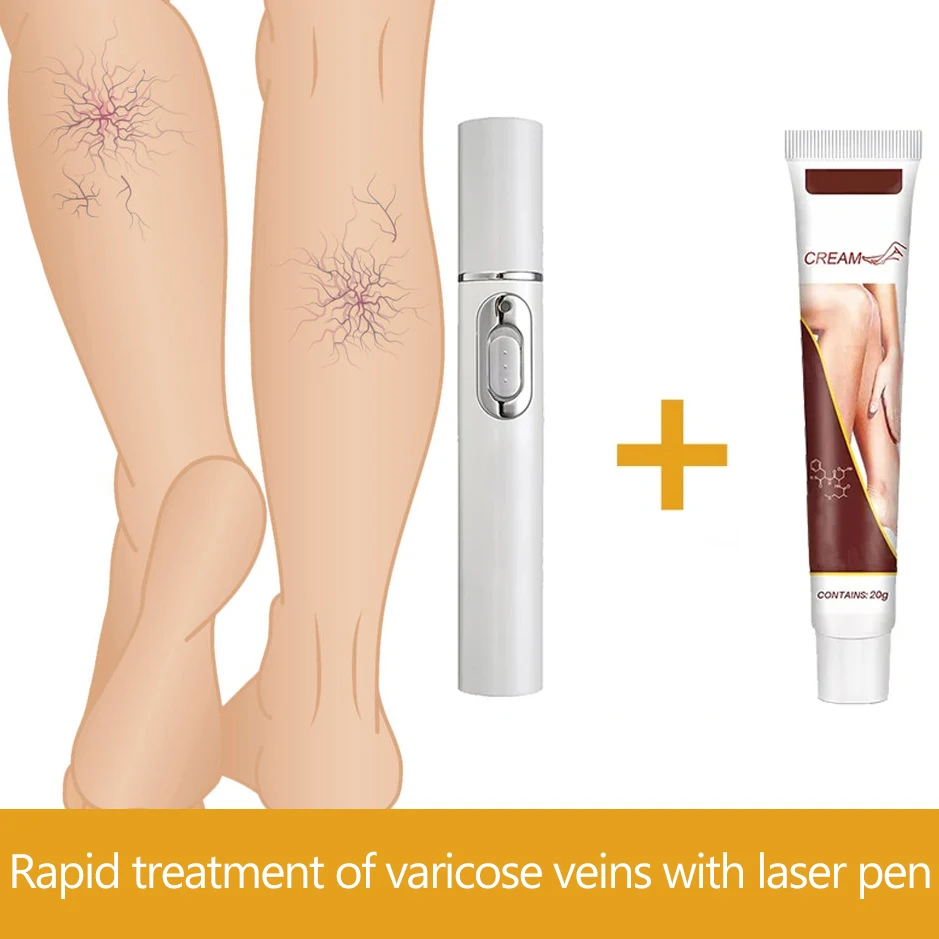 Varicose Vein Lampshade Therapy Effective Improved Blood Circulation Relief Of Dilated Vasculitis In The Legs Phlebitis
Varicose Vein Lampshade Therapy Effective Improved Blood Circulation Relief Of Dilated Vasculitis In The Legs Phlebitis