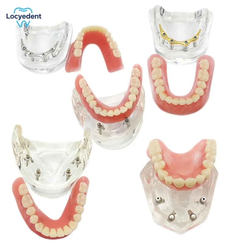 Dental Implant Overdenture Teeth Model 4 Implants M6008 Typodont Inferior Lower Restoration Demo Studying Education Model
Dental Implant Overdenture Teeth Model 4 Implants M6008 Typodont Inferior Lower Restoration Demo Studying Education Model