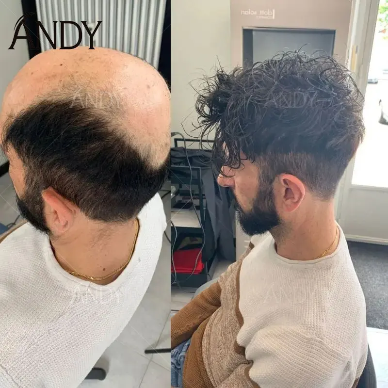 0.03mm Ultra Thin Skin Base Men's Capillary Prosthesis V-Loop Invisible Hairline Men Toupee Natural Human Hair System Male Wigs
0.03mm Ultra Thin Skin Base Men's Capillary Prosthesis V-Loop Invisible Hairline Men Toupee Natural Human Hair System Male Wigs