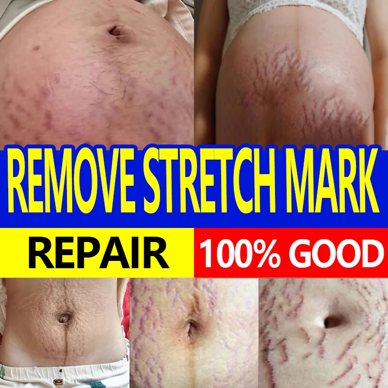 Postpartum elimination and removal of stretch marks caused by pregnancy, softening and firming of the belly, and repair cream
Postpartum elimination and removal of stretch marks caused by pregnancy, softening and firming of the belly, and repair cream