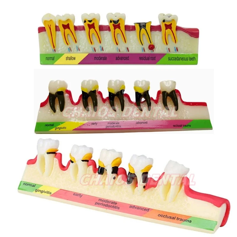 1Pcs/Box Dental Periodoontal Disease Model M4010 Caries illustration Model Explains the progress of Caries
1Pcs/Box Dental Periodoontal Disease Model M4010 Caries illustration Model Explains the progress of Caries