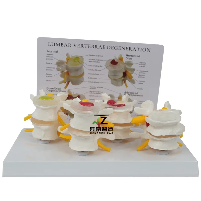 High quality 4-stage morbid lumbar spine comparative model Medical teaching model
High quality 4-stage morbid lumbar spine comparative model Medical teaching model