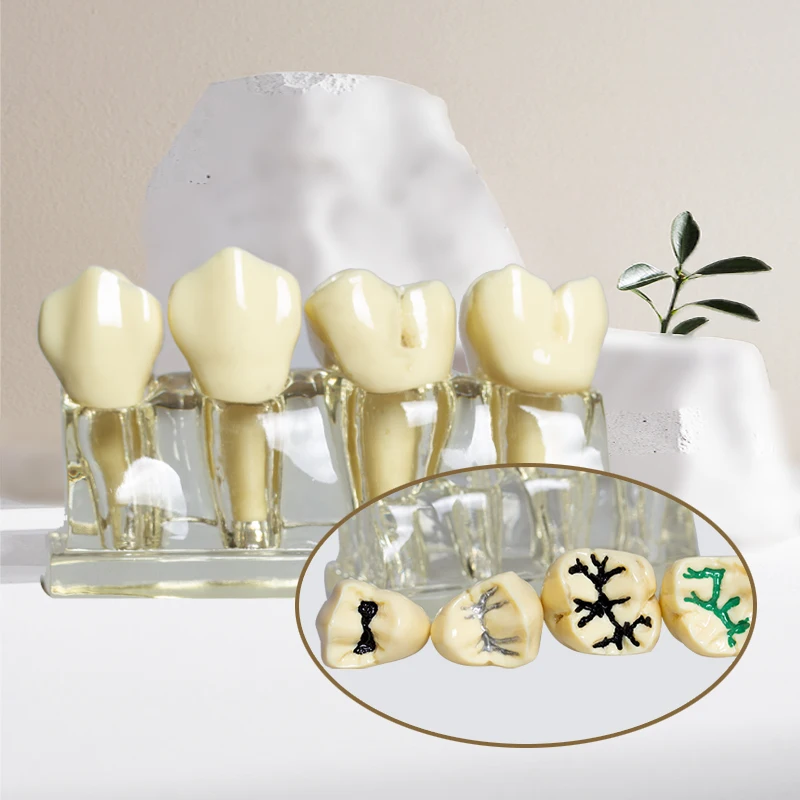 Dental pit and fissure sealing model, child anti caries tooth model, pit and fissure sealing operation, transparent model
Dental pit and fissure sealing model, child anti caries tooth model, pit and fissure sealing operation, transparent model