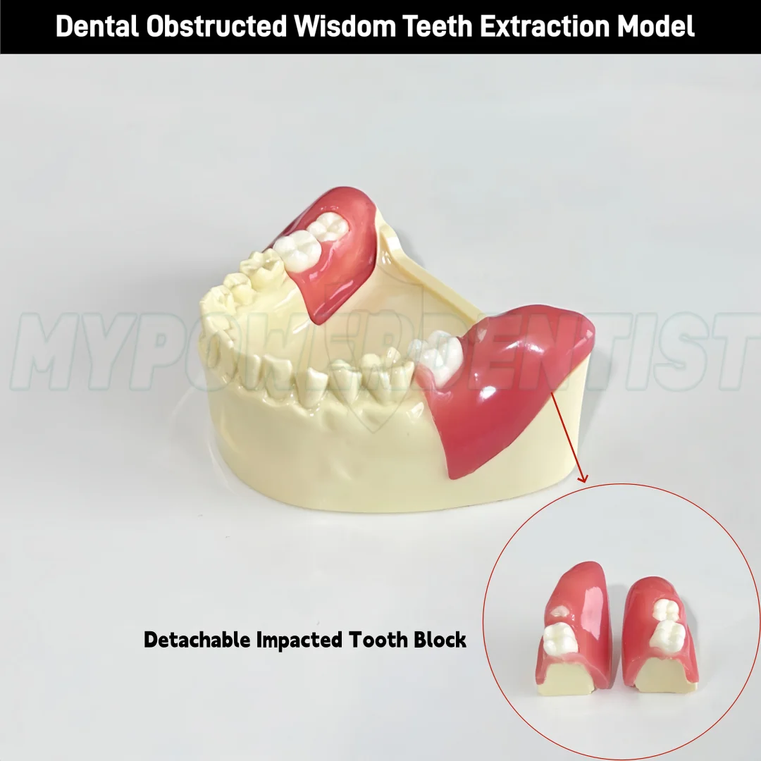Dental Obstructed Wisdom Teeth Extraction Model Lower Soft Gingiva Wisdom Model Dental Learning Practice Model
Dental Obstructed Wisdom Teeth Extraction Model Lower Soft Gingiva Wisdom Model Dental Learning Practice Model