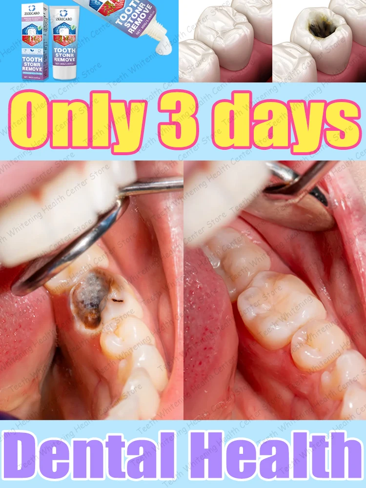 Healthy Teeth Remove Cavity Probiotics, 99% Repurchase
Healthy Teeth Remove Cavity Probiotics, 99% Repurchase