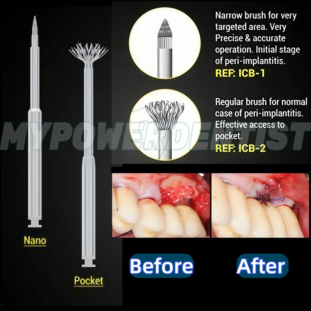 Dental Titanium Brush Surface Cleaning Brush Peri-implantitis Implant Debridement Bristles Dentist Tool Taper/Pocket Type
Dental Titanium Brush Surface Cleaning Brush Peri-implantitis Implant Debridement Bristles Dentist Tool Taper/Pocket Type