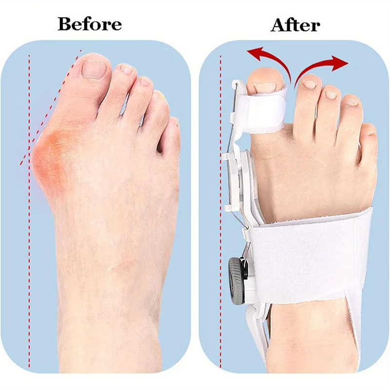 Корректор бурсита стопы унисекс, брекеты для ног, вальгусной деформации, вращающийся разделитель пальцев, выпрямитель, регулируемый корректор для пальцев и ног для педикюра
Корректор бурсита стопы унисекс, брекеты для ног, вальгусной деформации, вращающийся разделитель пальцев, выпрямитель, регулируемый корректор для пальцев и ног для педикюра