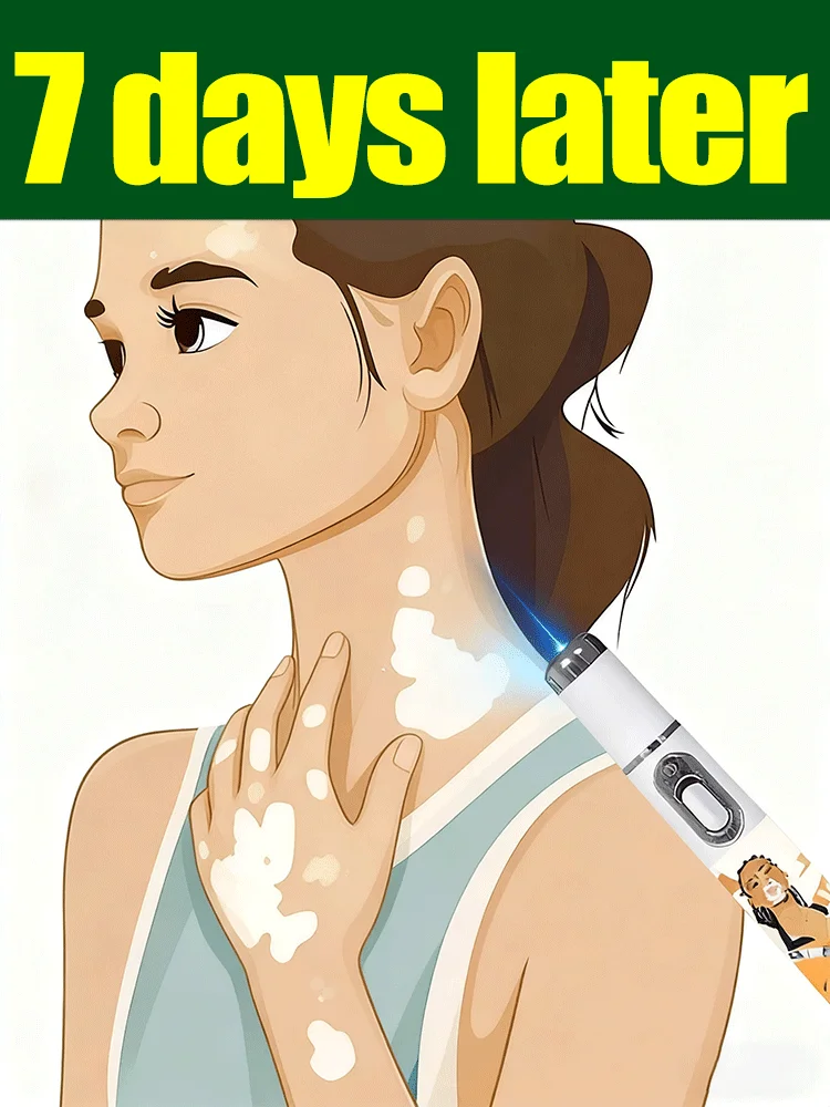 Improve vitiligo blue laser
Improve vitiligo blue laser