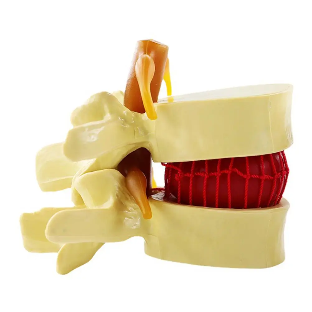 PVC Lumbar Disc Herniation Spine Model Realistic for Teaching Hospital Medical School Research Easy Clean Portable
PVC Lumbar Disc Herniation Spine Model Realistic for Teaching Hospital Medical School Research Easy Clean Portable