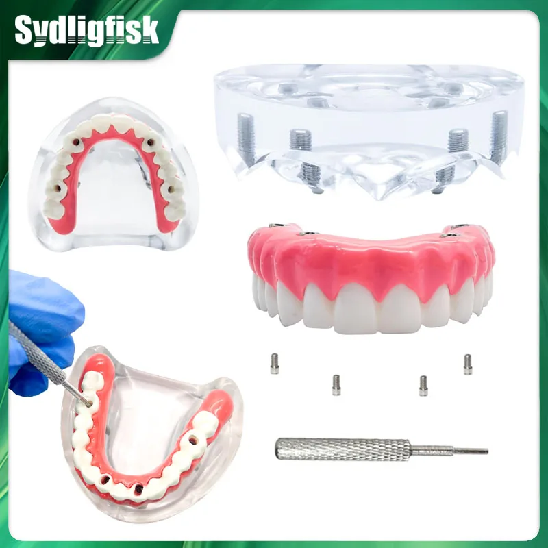 Dental Implant Teeth Model 4 Implant Overdenture Upper/Lower Jaw Restoration Removable Model Dentist Student Teaching Research
Dental Implant Teeth Model 4 Implant Overdenture Upper/Lower Jaw Restoration Removable Model Dentist Student Teaching Research