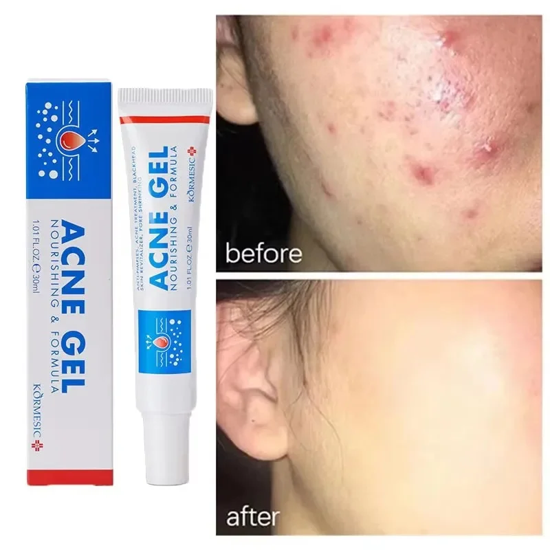 Effective Acne Removal Cream Anti-Acne Repair Redness Pimple Spots Gel Deep Cleaning Pore Oil Control Moisturizing Skin Care 30g
Effective Acne Removal Cream Anti-Acne Repair Redness Pimple Spots Gel Deep Cleaning Pore Oil Control Moisturizing Skin Care 30g