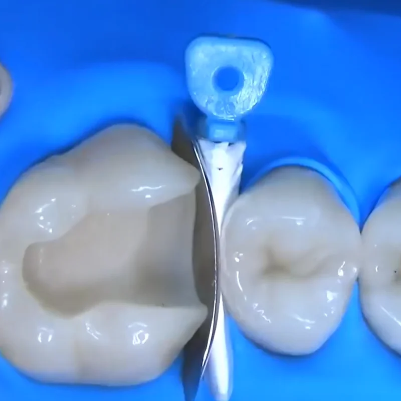 100PCS/BOX,Dental Hole Gap Wedge, Interproximal Surface Molding Anti-slip Design, Dedicated for Resin Filling,Restorations
100PCS/BOX,Dental Hole Gap Wedge, Interproximal Surface Molding Anti-slip Design, Dedicated for Resin Filling,Restorations