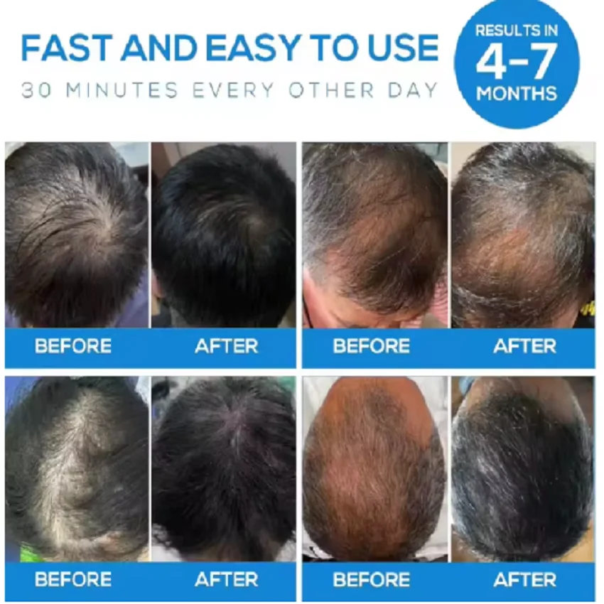 Лазерная шапка для роста волос 2760 мВт, 276 диодов, мощная лазерная шапка для восстановления роста волос
Лазерная шапка для роста волос 2760 мВт, 276 диодов, мощная лазерная шапка для восстановления роста волос