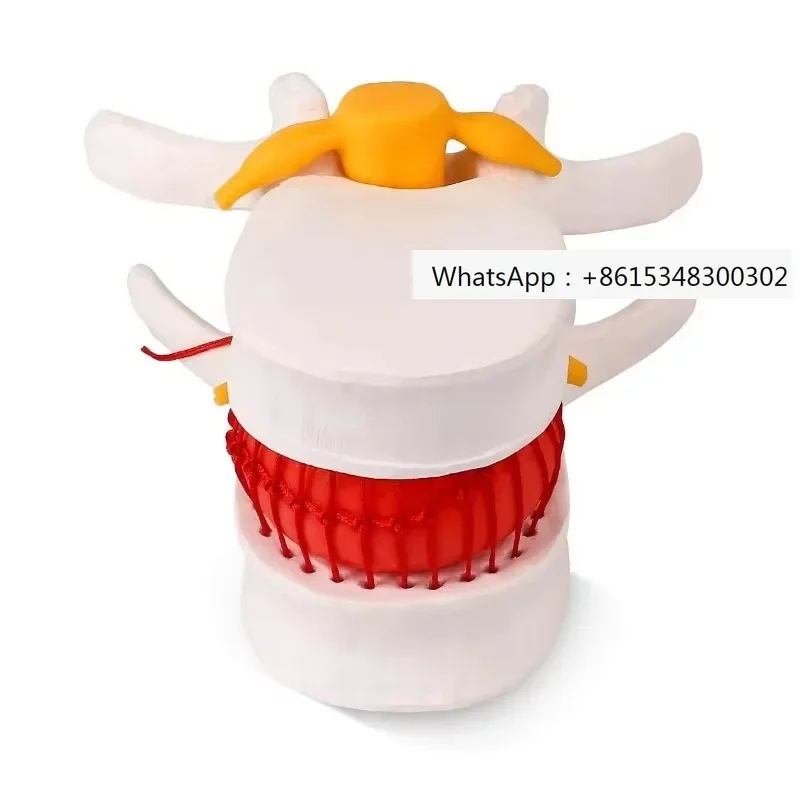 KyrenMed Human Intervertebral Lumbar Disc Herniation Model 1.5X Lumbar Spine Protrusion Anatomical Model with Elastic Software
KyrenMed Human Intervertebral Lumbar Disc Herniation Model 1.5X Lumbar Spine Protrusion Anatomical Model with Elastic Software