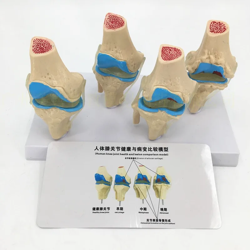 1 Pcs 1:1 Life Size Human Knee Joint Anatomy Skeleton/1set 4-Stages Knee Joint Anatomical Model Teaching Supplies
1 Pcs 1:1 Life Size Human Knee Joint Anatomy Skeleton/1set 4-Stages Knee Joint Anatomical Model Teaching Supplies