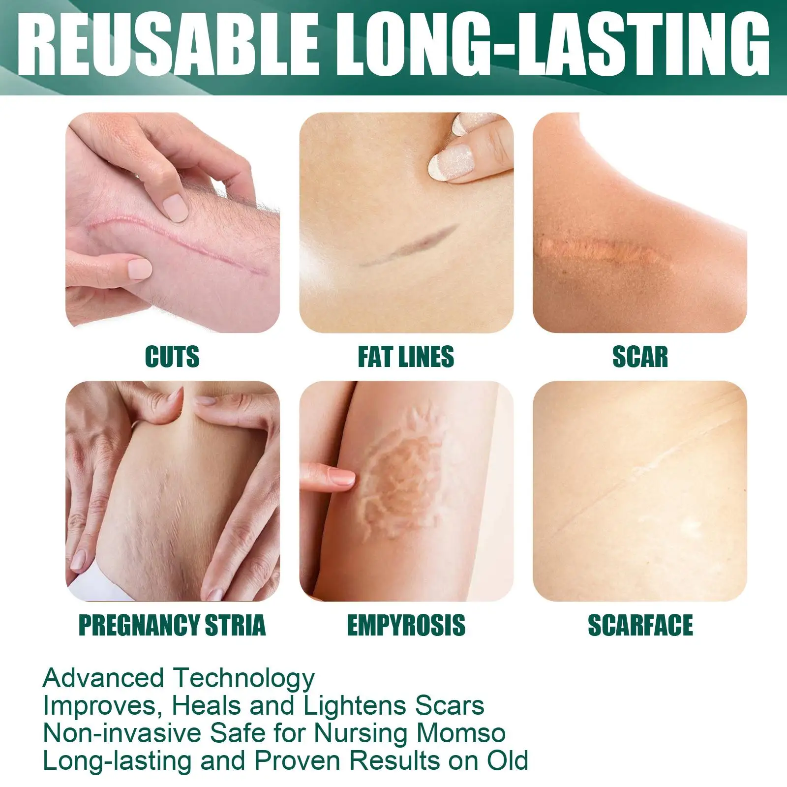 Reusable silicone removal films, keloids soften old and new ones
Reusable silicone removal films, keloids soften old and new ones