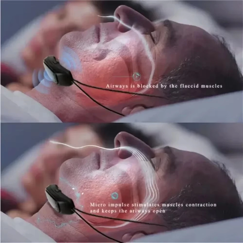 Умное устройство против храпа для мужчин — портативная технология импульсов EMS с контролем шума, ночной комфорт, поддержка сна для путешествий
Умное устройство против храпа для мужчин — портативная технология импульсов EMS с контролем шума, ночной комфорт, поддержка сна для путешествий