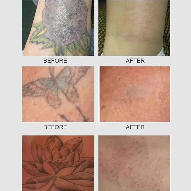 exquisite craftsmanship Newest Tattoo Removal Machine Portable Pico 755 1064 532nm Hive Picosecond Rejuvenation Machine
exquisite craftsmanship Newest Tattoo Removal Machine Portable Pico 755 1064 532nm Hive Picosecond Rejuvenation Machine