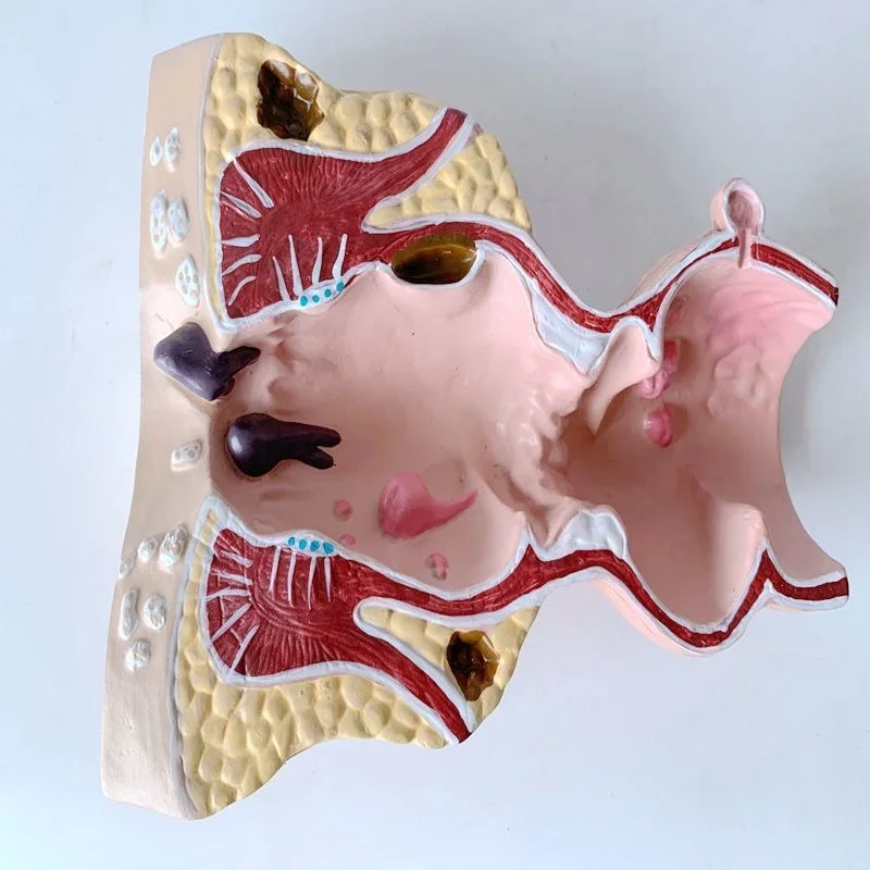 Human colorectal model rectal pathological anatomy model
Human colorectal model rectal pathological anatomy model