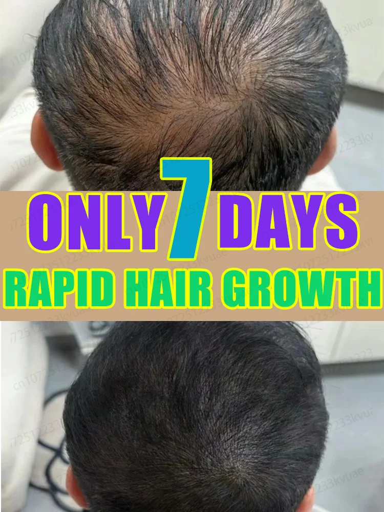 Rapidly repair hair loss and baldness, powerful effect will make you look younger in seven days
Rapidly repair hair loss and baldness, powerful effect will make you look younger in seven days