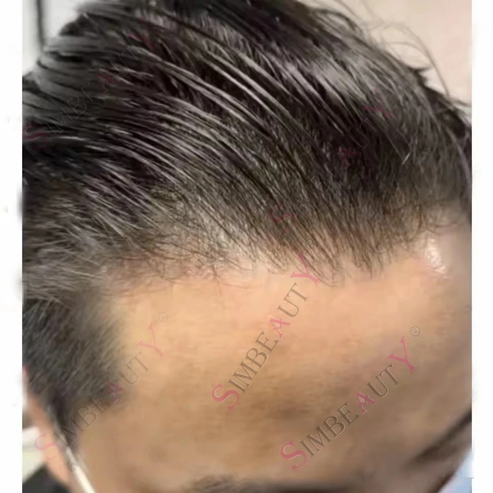 0.02-0.03mm Super Thin Skin Dark Brown Human Hair Replacement Men Toupee Undetectable Full Pu 80%-100%Density Vloop Grey Prosths
0.02-0.03mm Super Thin Skin Dark Brown Human Hair Replacement Men Toupee Undetectable Full Pu 80%-100%Density Vloop Grey Prosths