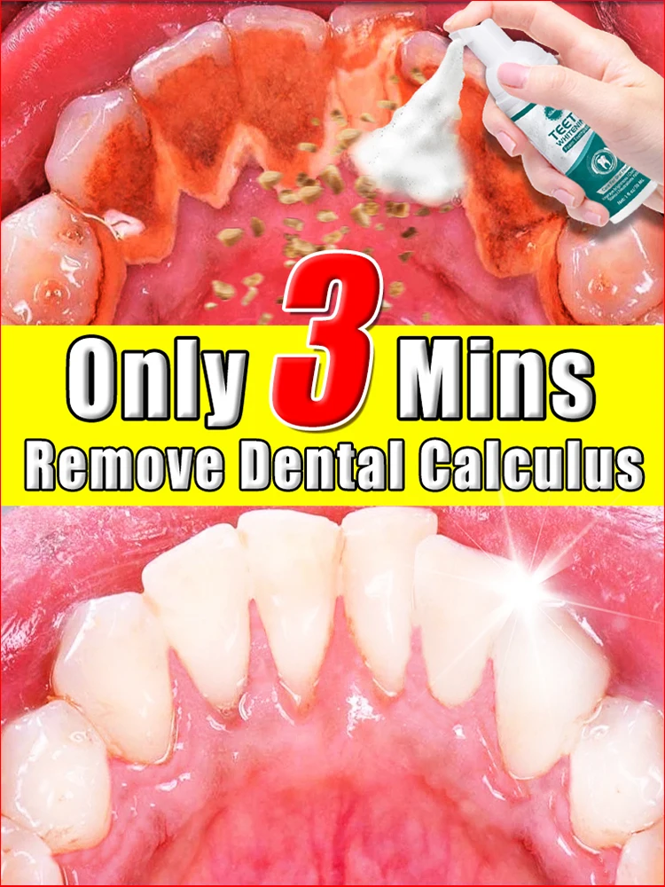Dental Calculus Remover Teeth Whitening Mousse Removal Halitosis Plaque Stains Fresh Breath Care Mouth Cleaning Oral Hygiene
Dental Calculus Remover Teeth Whitening Mousse Removal Halitosis Plaque Stains Fresh Breath Care Mouth Cleaning Oral Hygiene