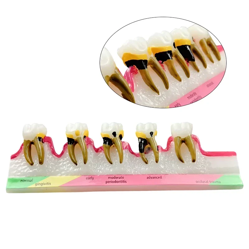 Dental Periodontal Disease Assort Demo Teeth Model 5 Stage three-Dimensional Proportional Magnification Design for Dentist
Dental Periodontal Disease Assort Demo Teeth Model 5 Stage three-Dimensional Proportional Magnification Design for Dentist