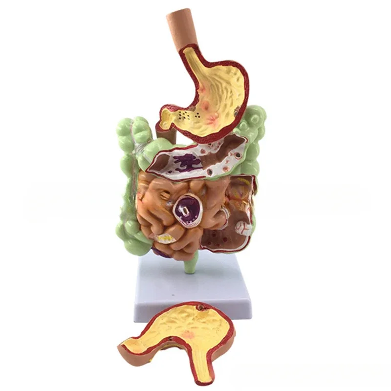 Colorectal pathology model, gastrointestinal model, colorectal lesion model, intestinal disease, human colon lesion model
Colorectal pathology model, gastrointestinal model, colorectal lesion model, intestinal disease, human colon lesion model