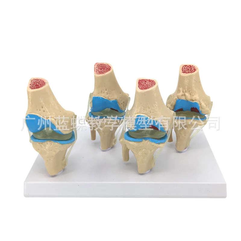 Pathological Knee Joint Model Four-Stage Pathological Knee Joint Model Pathological Human Knee Joint Model
Pathological Knee Joint Model Four-Stage Pathological Knee Joint Model Pathological Human Knee Joint Model