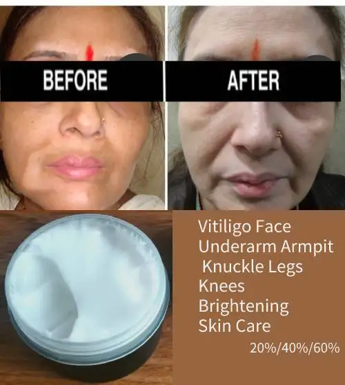 Vitiligo Cream 20 40 60% WHITE FACE WHITENING CREAM FADES SKIN TONE CLEARS BLEMISHES AGE SPOTS Skin Bleaching and Lightening
Vitiligo Cream 20 40 60% WHITE FACE WHITENING CREAM FADES SKIN TONE CLEARS BLEMISHES AGE SPOTS Skin Bleaching and Lightening