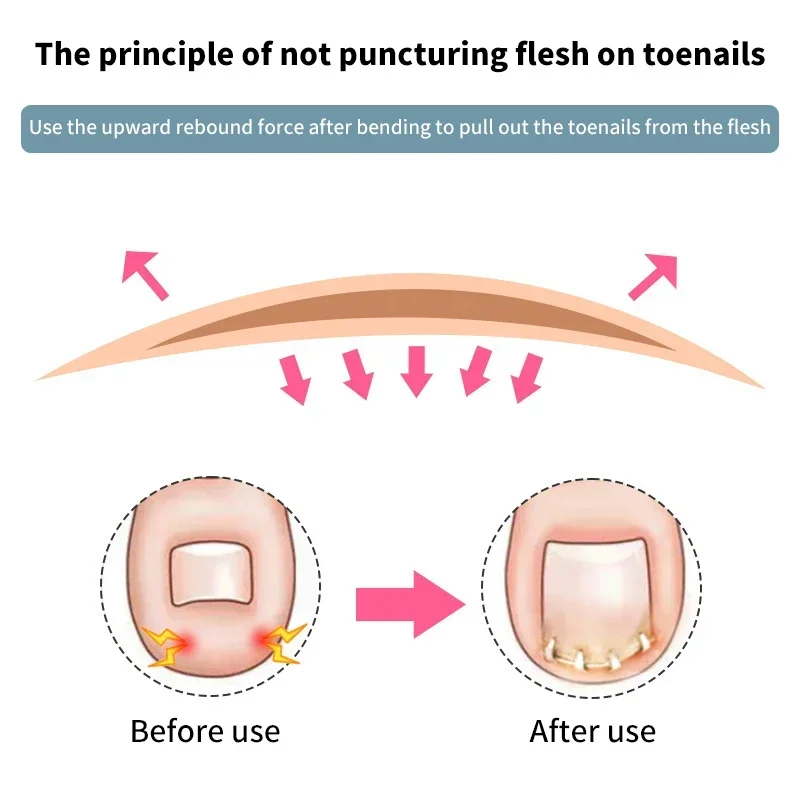 1 шт., невидимый инструмент для коррекции вросших ногтей, эластичный выпрямляющий зажим для педикюра, ухода за ногтями
1 шт., невидимый инструмент для коррекции вросших ногтей, эластичный выпрямляющий зажим для педикюра, ухода за ногтями