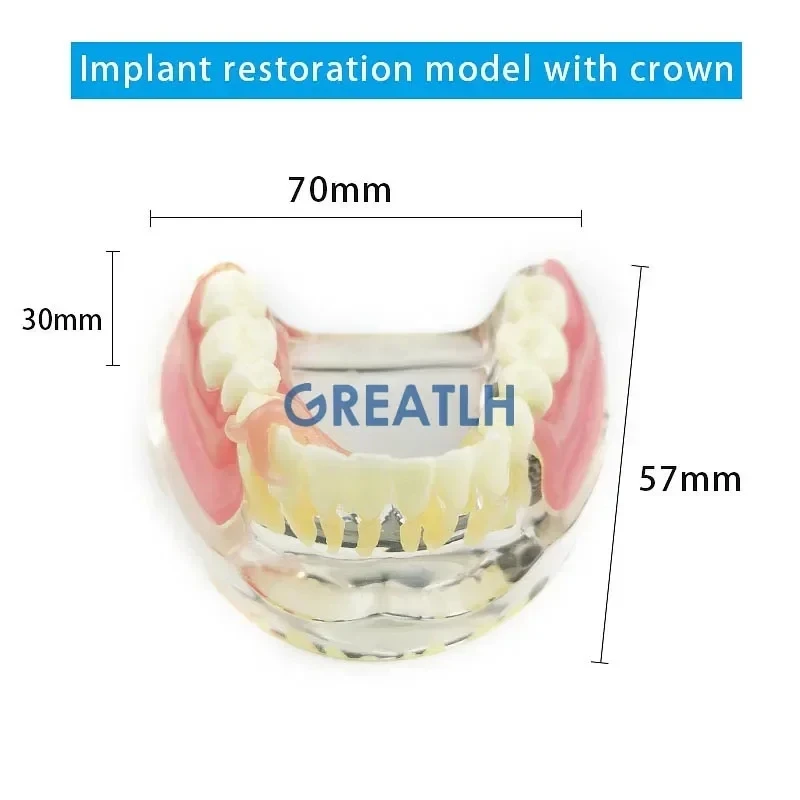 Multiple Types Dental Implant Model Typodont with Silver/Golden Bar Lower Restoration Demo Model Dental Teaching Models
Multiple Types Dental Implant Model Typodont with Silver/Golden Bar Lower Restoration Demo Model Dental Teaching Models