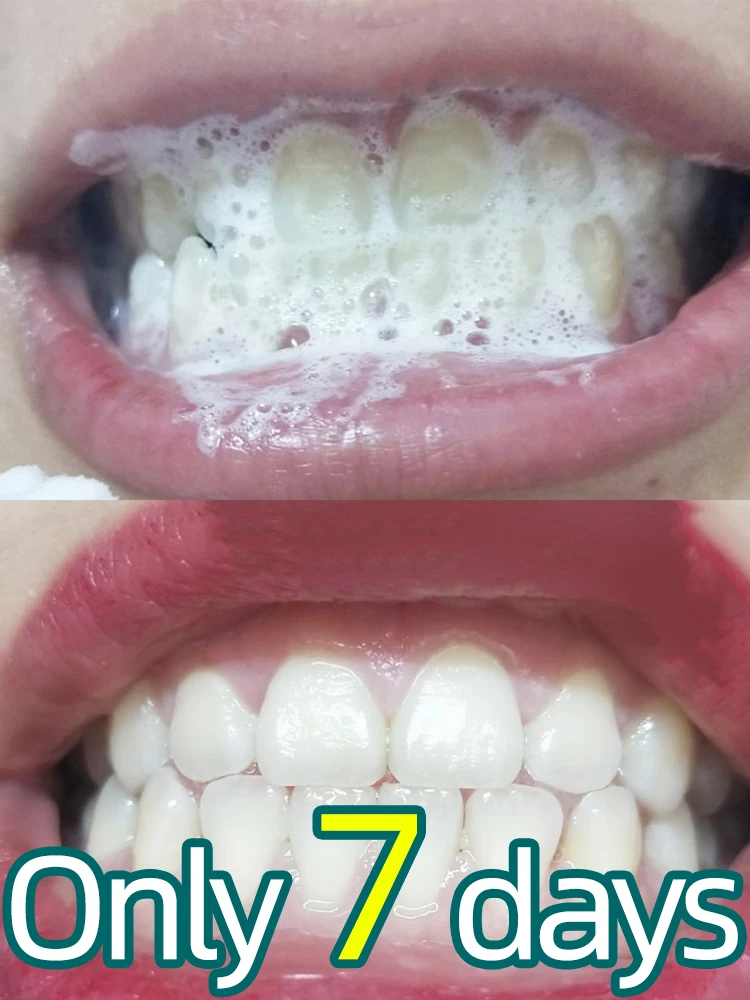 Tartar removers dissolve tartar and remove stains
Tartar removers dissolve tartar and remove stains