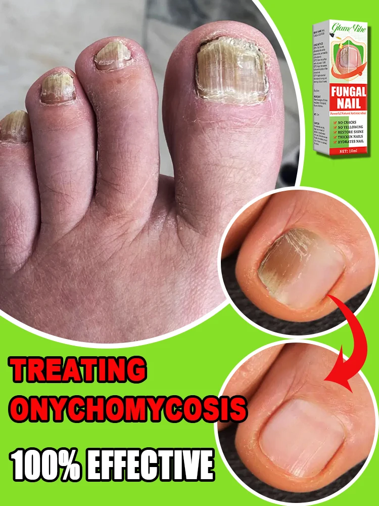 Good news for patients with onychomycosis! 
Good news for patients with onychomycosis!