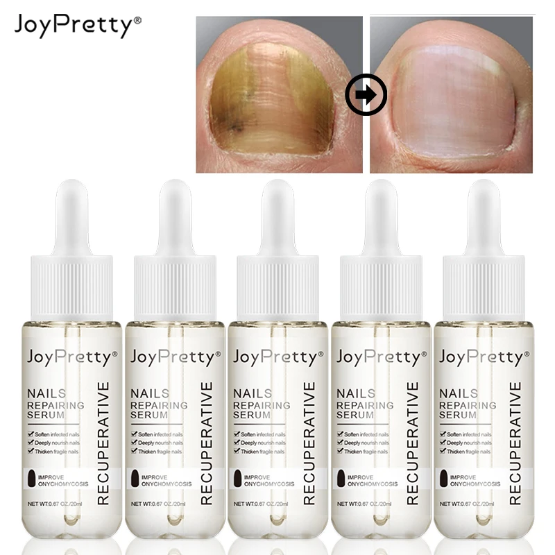 JoyPretty Nail Fungus Foot Treatment Products Cuticle Oil Nails Polish Gel Regrowth Serum Remedy Toenail Finger Feet Fungal Care
JoyPretty Nail Fungus Foot Treatment Products Cuticle Oil Nails Polish Gel Regrowth Serum Remedy Toenail Finger Feet Fungal Care