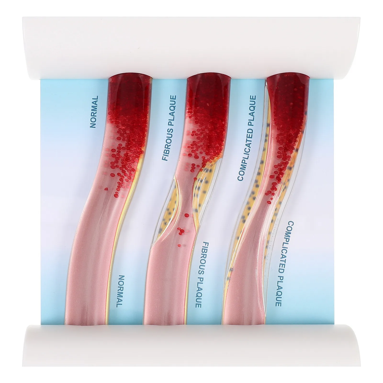 Low-Density Lipoprotein Blood Vessel Anatomical Dynamic Plastic Vascular Teaching Aid for Cardiovascular and Diabetes Awareness
Low-Density Lipoprotein Blood Vessel Anatomical Dynamic Plastic Vascular Teaching Aid for Cardiovascular and Diabetes Awareness
