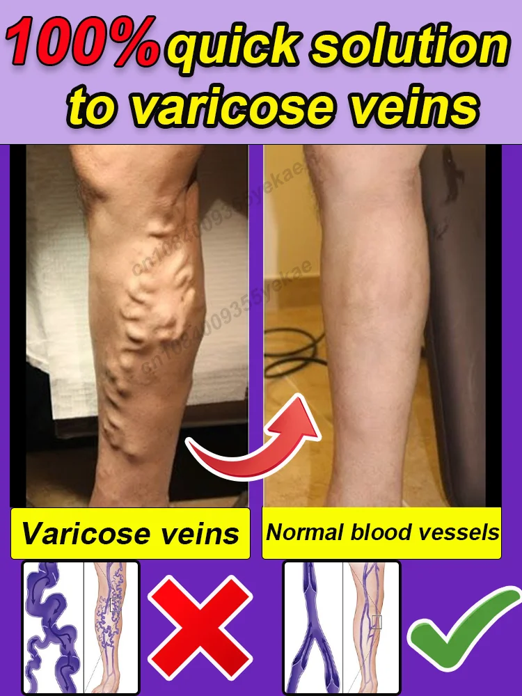 Laser improves veins, relieves pressure on the legs, improves blood circulation, varicose veins
Laser improves veins, relieves pressure on the legs, improves blood circulation, varicose veins