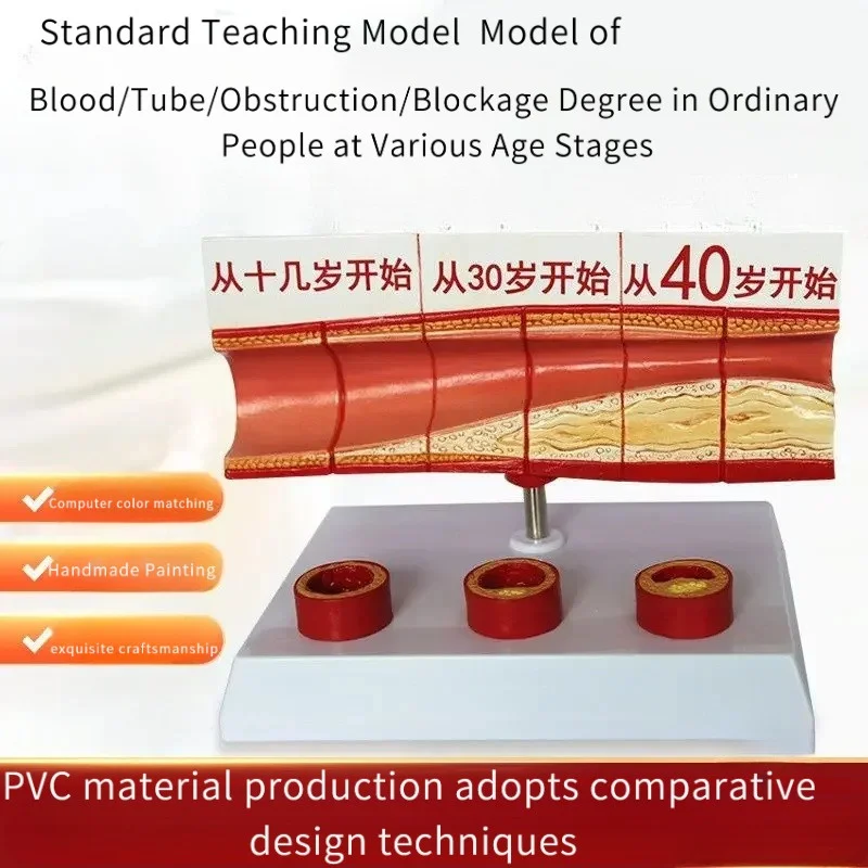 Large Vessel Occlusion Blood Concentration Fat Vessel Atherosclerosis Pathological Anatomy Model Medical Teaching Tool
Large Vessel Occlusion Blood Concentration Fat Vessel Atherosclerosis Pathological Anatomy Model Medical Teaching Tool
