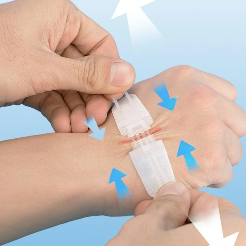 Portable Zipper Tie Wound Closure Patch Hemostatic Patch Wound Fast Without Suture Zipper Outdoor Band-Aid Quick Clot Wound
Portable Zipper Tie Wound Closure Patch Hemostatic Patch Wound Fast Without Suture Zipper Outdoor Band-Aid Quick Clot Wound