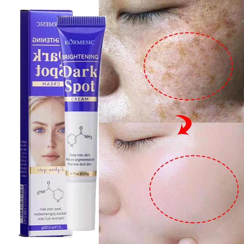 Whitening Freckle Cream Dark Spots Remover Serum Ointment Face Freckle Melanin Correcting Anti Pigmentation Brighten Skin Care
Whitening Freckle Cream Dark Spots Remover Serum Ointment Face Freckle Melanin Correcting Anti Pigmentation Brighten Skin Care